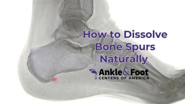 Can foot bone spurs disappear?