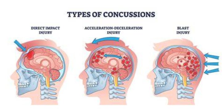 Can you have a concussion without a mark?