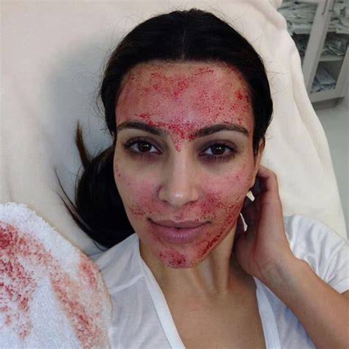 Did Kim Kardashian get a vampire facial?