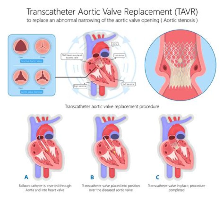 How long does a TAVR valve last?