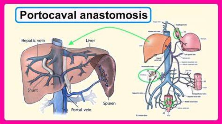 What is portacaval node?